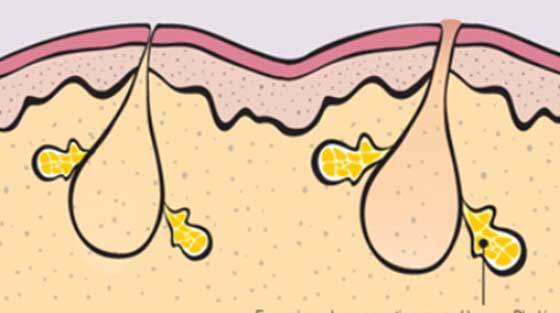 What is Selective Sebum Absorption?